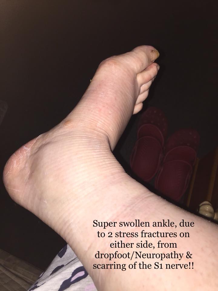 Swollen Ankle - Neuropathy